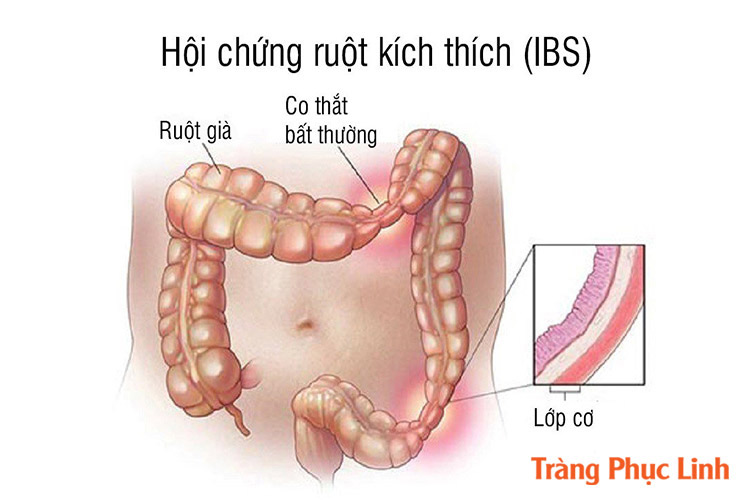 bi-dau-bung-di-cau-vao-buoi-sang-3-4-lan-la-trieu-chung-cua-hoi-chung-ruot-kich-thich