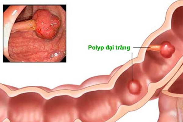 đau quặn bụng khi đi đại tiện